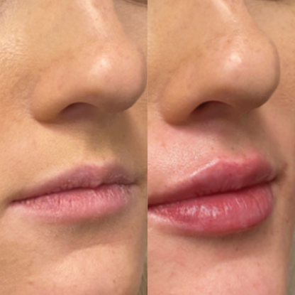 RestoraSeal |  The Hydrating and Moisterizing Mouth Tape