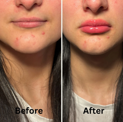 RestoraSeal |  The Hydrating and Moisterizing Mouth Tape